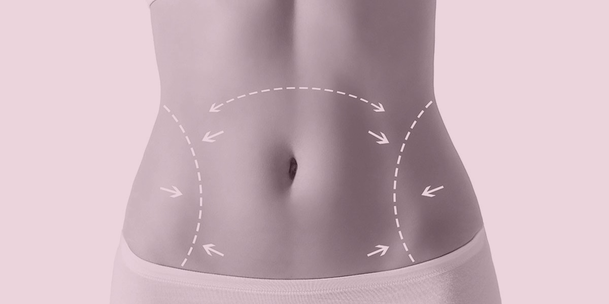 Абдоминопластика. Пластика живота