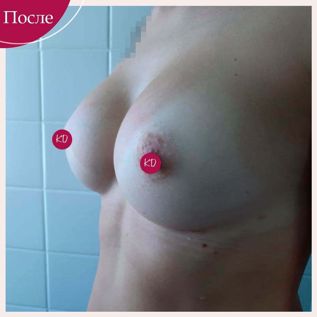 Збільшення грудей (Motiva Ergonomix full 375 ml)