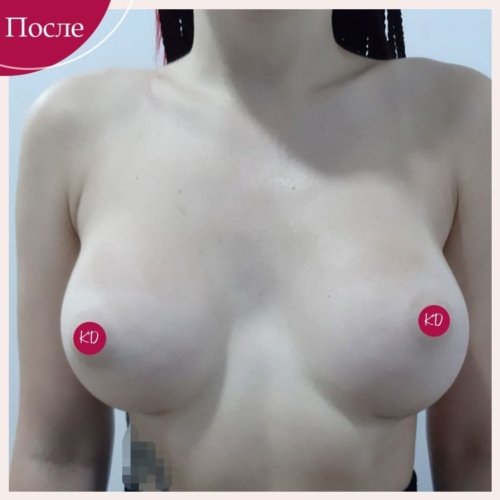 Увеличение груди в Киеве