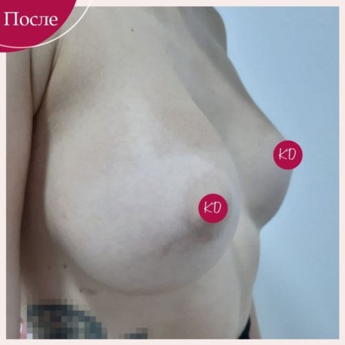 Увеличение груди в Киеве