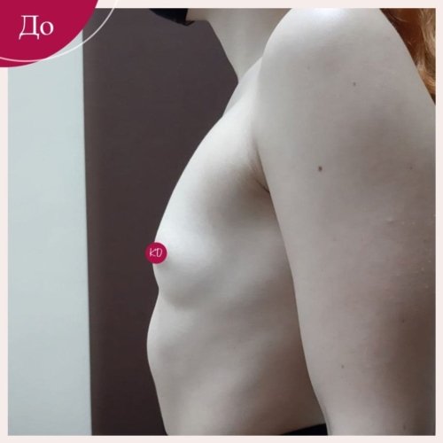 Увеличение груди в Киеве