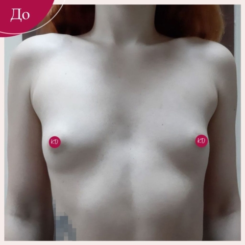 Увеличение груди в Киеве