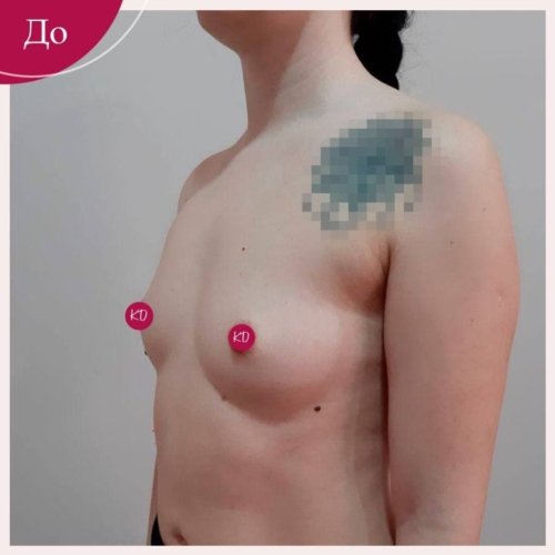 Имплантация груди Киев