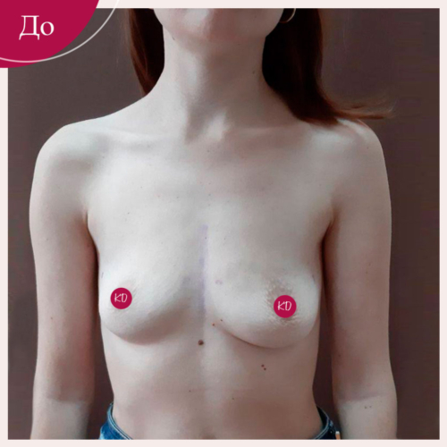 Увеличение и подтяжка груди Киев
