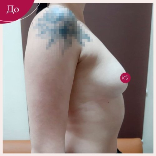 Увеличение груди в Киеве