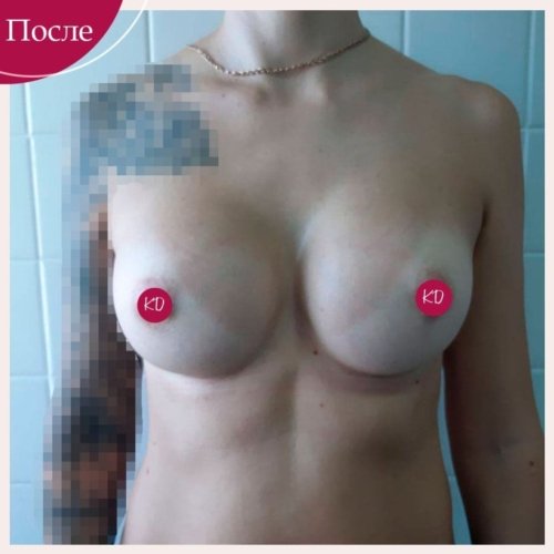 Увеличение груди в Киеве