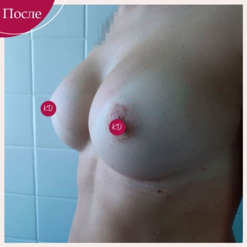 Увеличение груди в Киеве