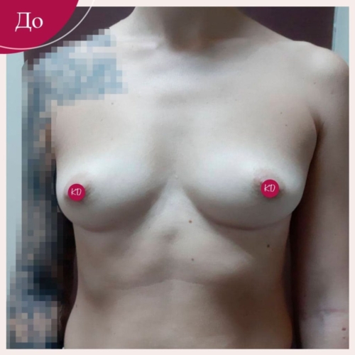 Увеличение груди в Киеве