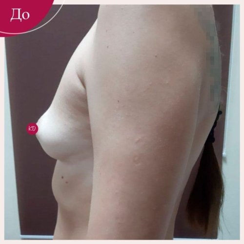 Увеличение груди в Киеве