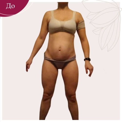 Липосакция и абдоминопластика