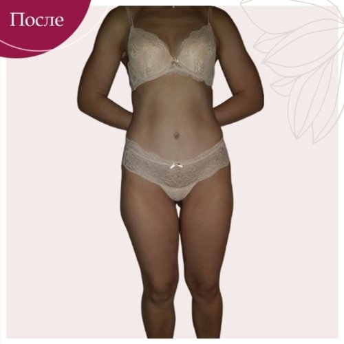 Липосакция и абдоминопластика