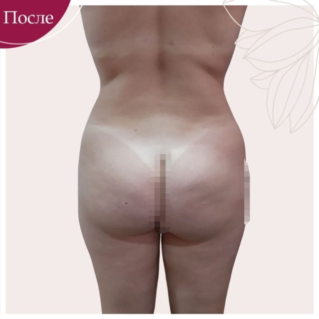 Липосакция и абдоминопластика