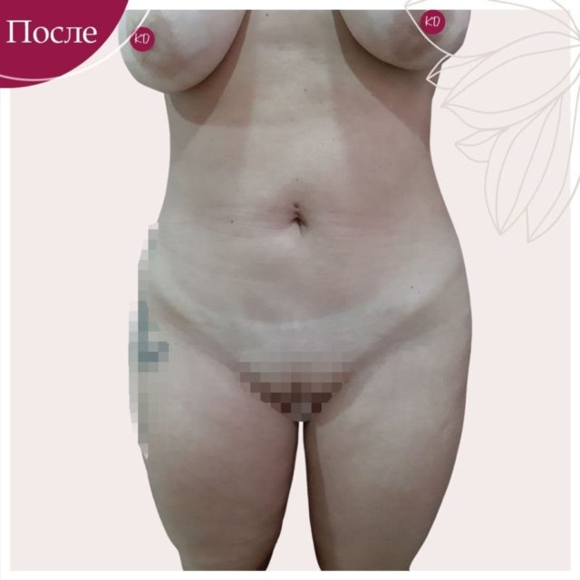 Липосакция и абдоминопластика