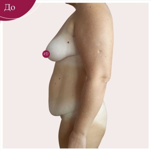 Абдоминопластика Киев