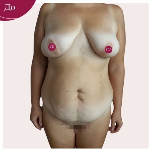 Абдоминопластика Киев
