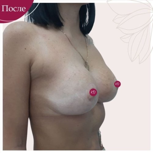 Увеличение и пластика груди