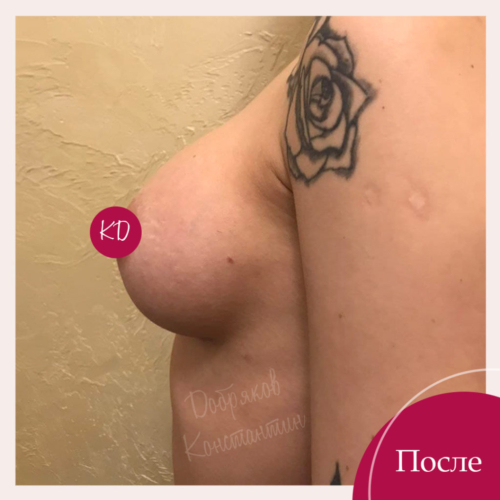 Подтяжка и увеличение груди Киев