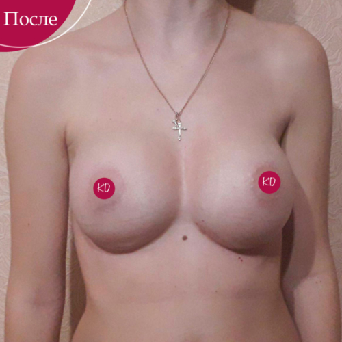 Увеличение и подтяжка груди Киев
