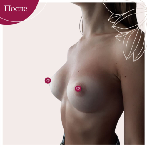 Увеличение груди в Киеве