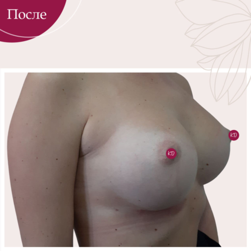 Увеличение груди Киев