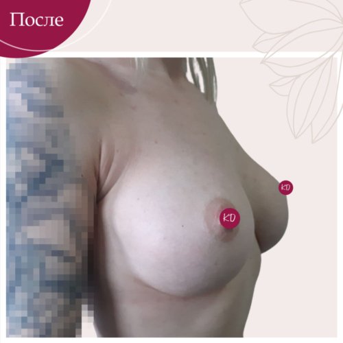 Увеличение груди Киев