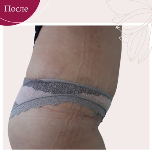 Абдоминопластика в Киеве