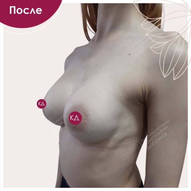 Маммопластика. Пластика и подтяжка груди