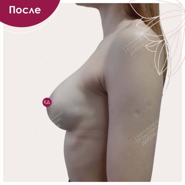 Маммопластика. Пластика и подтяжка груди