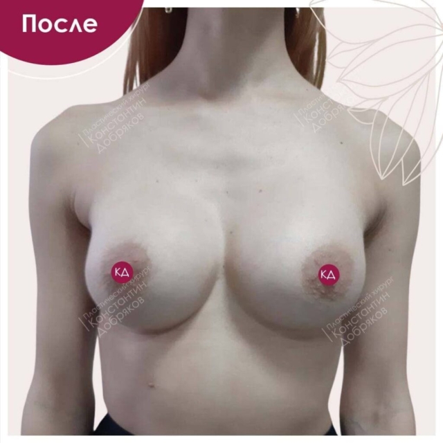 Маммопластика. Пластика и подтяжка груди