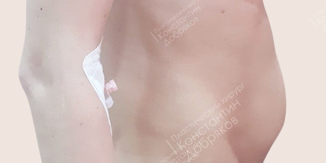 Пластика диастаза прямых мышц живота