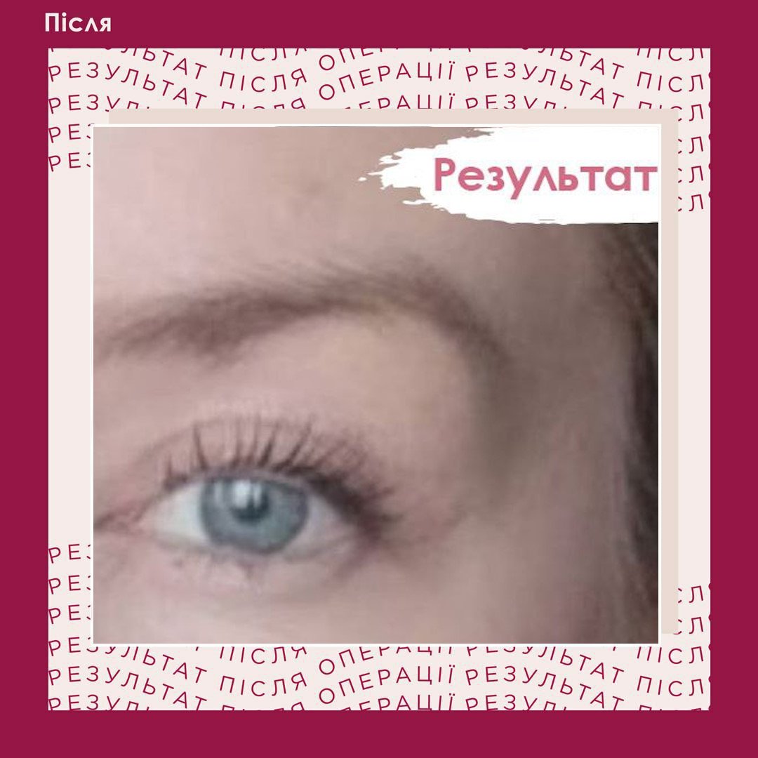 Кругова блефаропластика
